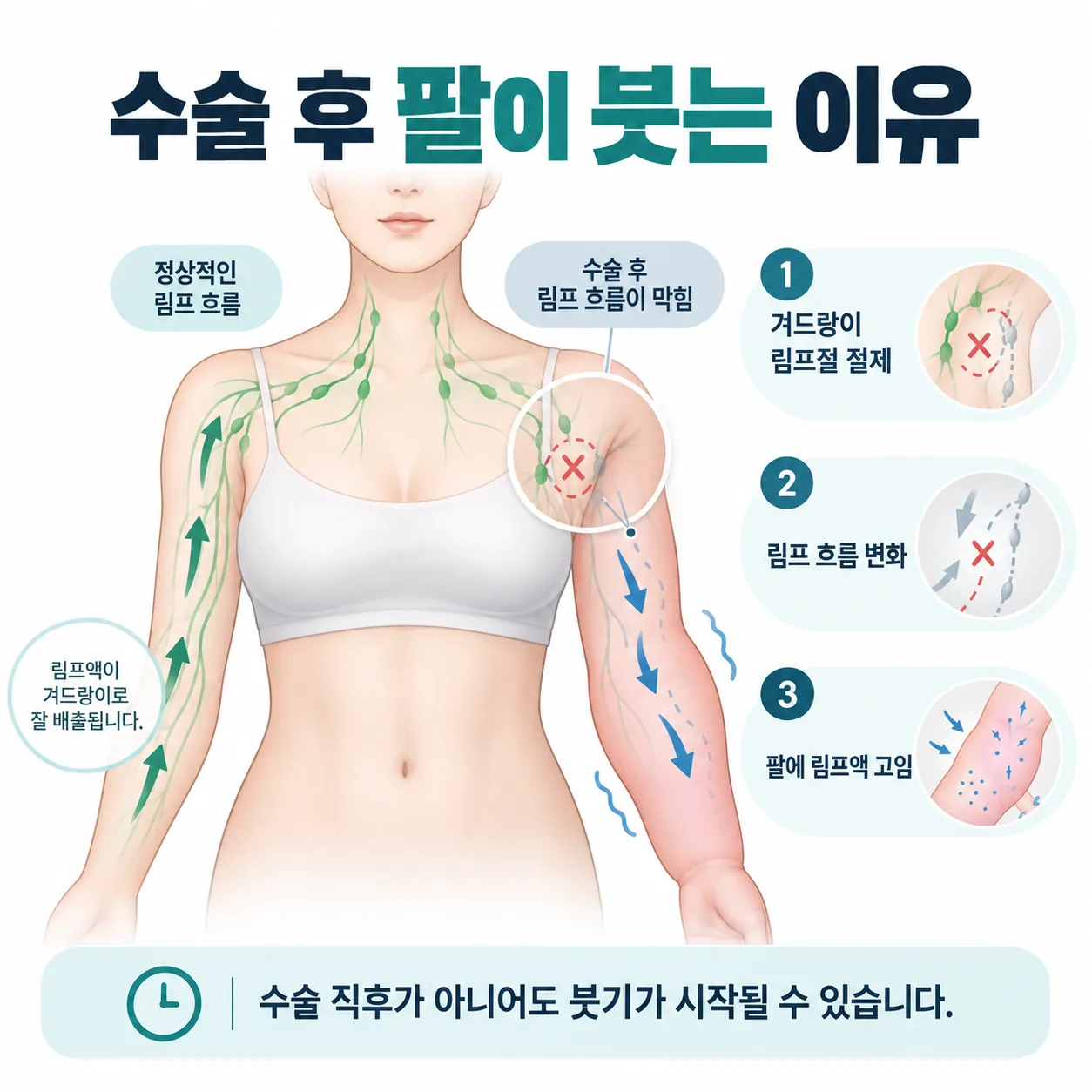 림프절 절제 후 림프액이 팔에 고이는 구조를 나타낸 개념도